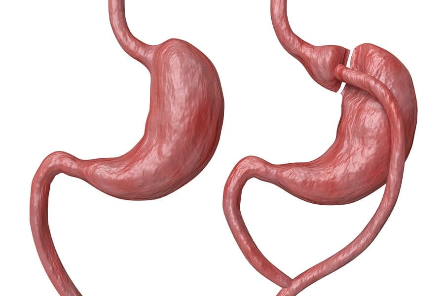 bypass gastrique operation chirurgie obesite docteur yann assaf chirurgien bariatrique paris