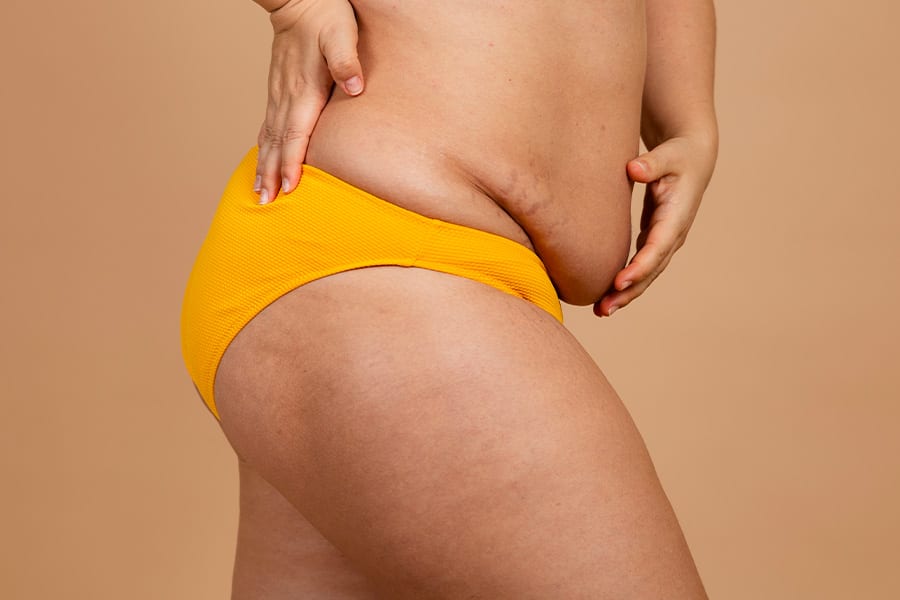 dermolipectomie abdominale abdominoplastie operation bariatrique docteur yann assaf chirurgien obesite paris