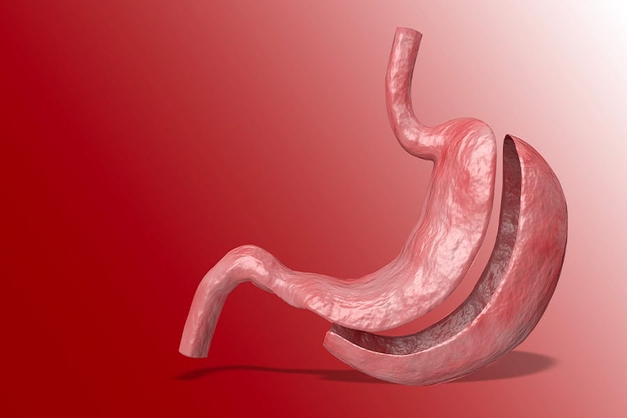 sleeve gastrectomie operation bariatrique docteur yann assaf chirurgien obesite paris